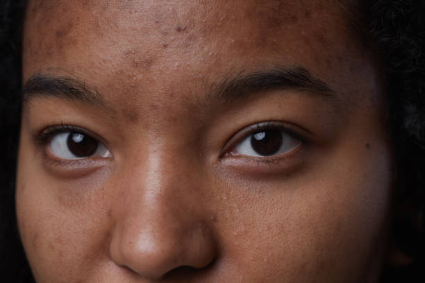 istock Skin Imerfections Close Up 1308641691