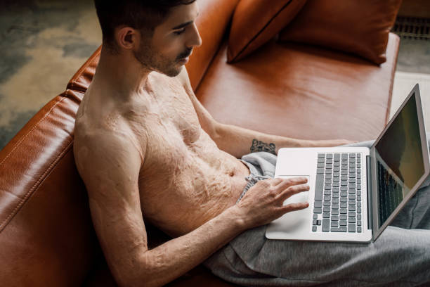 istock Man with scars at the skin after burn sitting at the sofa with laptop computer 1308645949