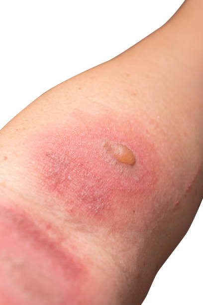 istock Blister from Rove beetles ,Paederus dermatitis at arm 1308717203