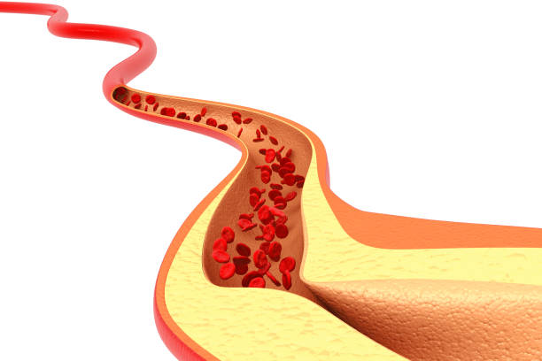 istock Cholesterol plaque in artery. 3d illustration 1308815832