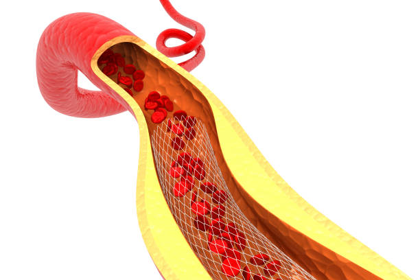 istock Stent angioplasty on white background. 3d render 1308826133