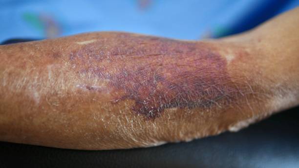 istock Large bruise on senior people arm 1308841724
