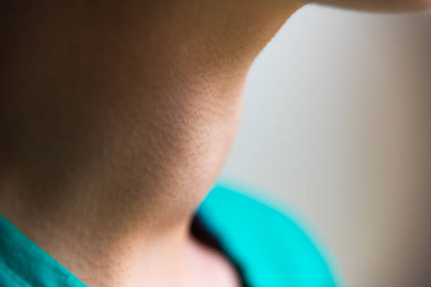 macro primo piano ritratto del profilo del collo della giovane donna con sintomi di ipertiroidismo della malattia di grave di gozzo tiroideo allargato - camposanto monumentale foto e immagini stock