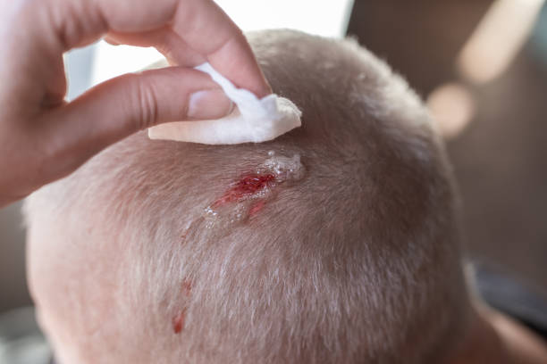 Injury to the scalp. Blood leaks from a chopped wound on the head. A woman is cleaning a wound with a cotton swab with hydrogen peroxide. First aid Injury to the scalp. Blood leaks from a chopped wound on the head. A woman is cleaning a wound with a cotton swab with hydrogen peroxide. First aid. hydrogen peroxide stock pictures, royalty-free photos & images