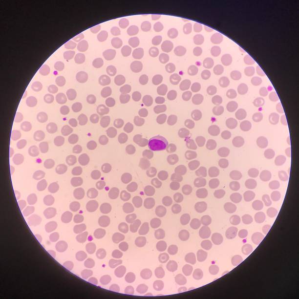 림프 구. - leukemia pathologist blood hematologist 뉴스 사진 이미지