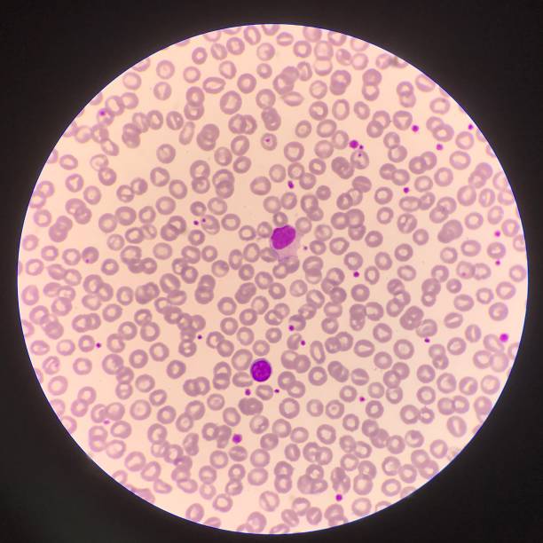 림프 구. - leukemia pathologist blood hematologist 뉴스 사진 이미지