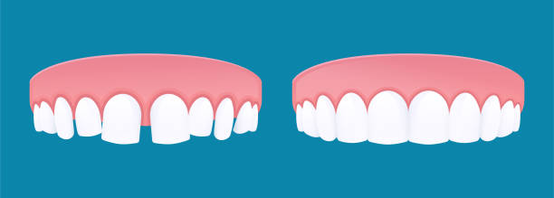 ilustrações de stock, clip art, desenhos animados e ícones de diastema teeth with dental spacing and healthy teeth. vector cartoon style. - unevenly