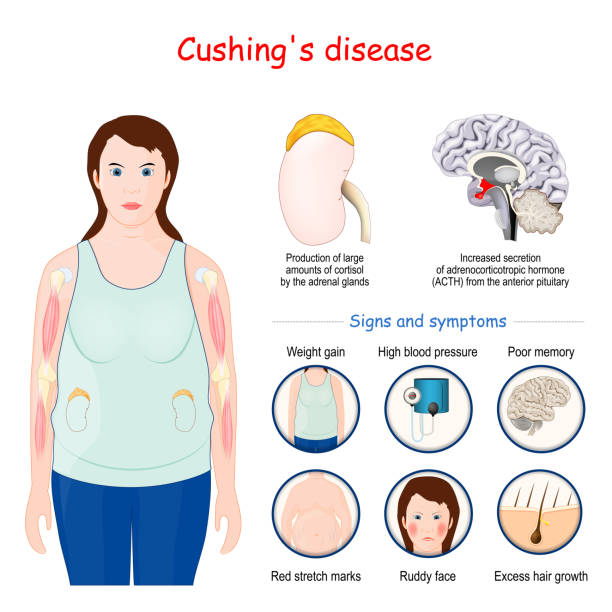 ilustrações, clipart, desenhos animados e ícones de a doença de cushing. sinais e sintomas da síndrome de cushing - sindrome de cushing