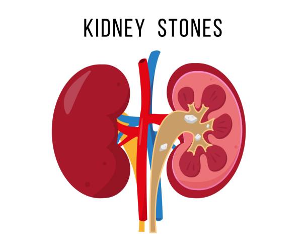 ilustrações, clipart, desenhos animados e ícones de doença da pedra nos rins. sistema urinário doente humano. - kidney stone