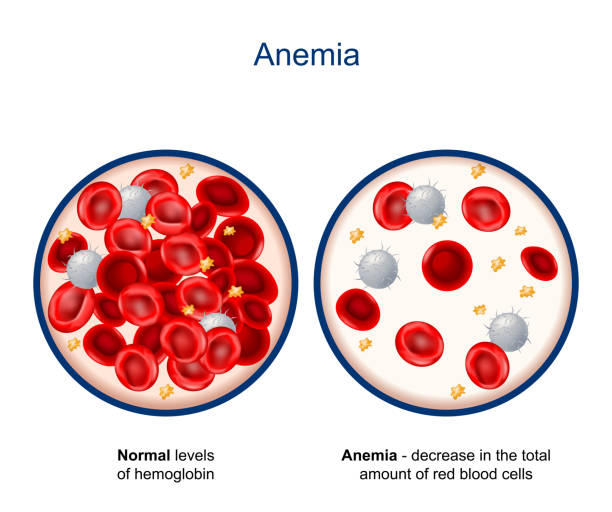 Anemia. Close-up of blood vessel with erythrocyte, platelets and white blood cells (lymphocytes) Anemia. comparison and difference between Normal levels of hemoglobin and decrease in the total amount of red blood cells. Close-up of blood vessel with erythrocyte, platelets and white blood cells (lymphocytes) anemia diagram stock illustrations