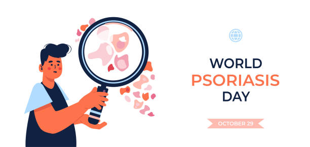 istock World Psoriasis Day or Awareness Month. 29 october. Plaques of psoriasis seen through a magnifying glass. 1309275172