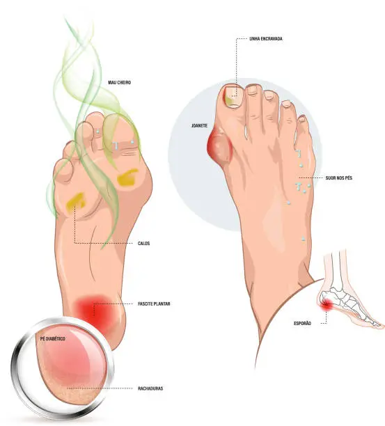 Vector illustration of Dealing with foot diseases, diabetic foot, bad smell, calluses, fasceitis, cracks, bunions, ingrown nails, protrusions on feet