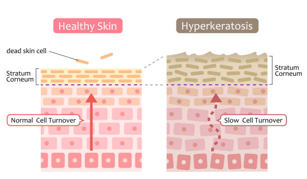 illustrazioni stock, clip art, cartoni animati e icone di tendenza di diagramma del ricambio delle cellule della pelle e ispessimento dello strato corneo. concetto di cura della pelle e bellezza - peeling