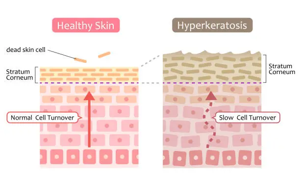 Vector illustration of diagram of skin cell turnover and thickening of the stratum corneum. Skin care and beauty concept