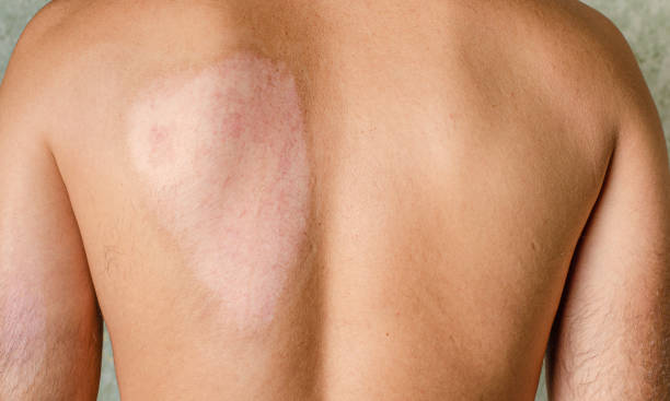 cicatrice guérie après brûlure de peau de deuxième degré - grafted photos et images de collection