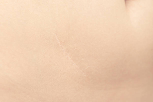 istock beautiful neat scar after appendectomy. 1309686930