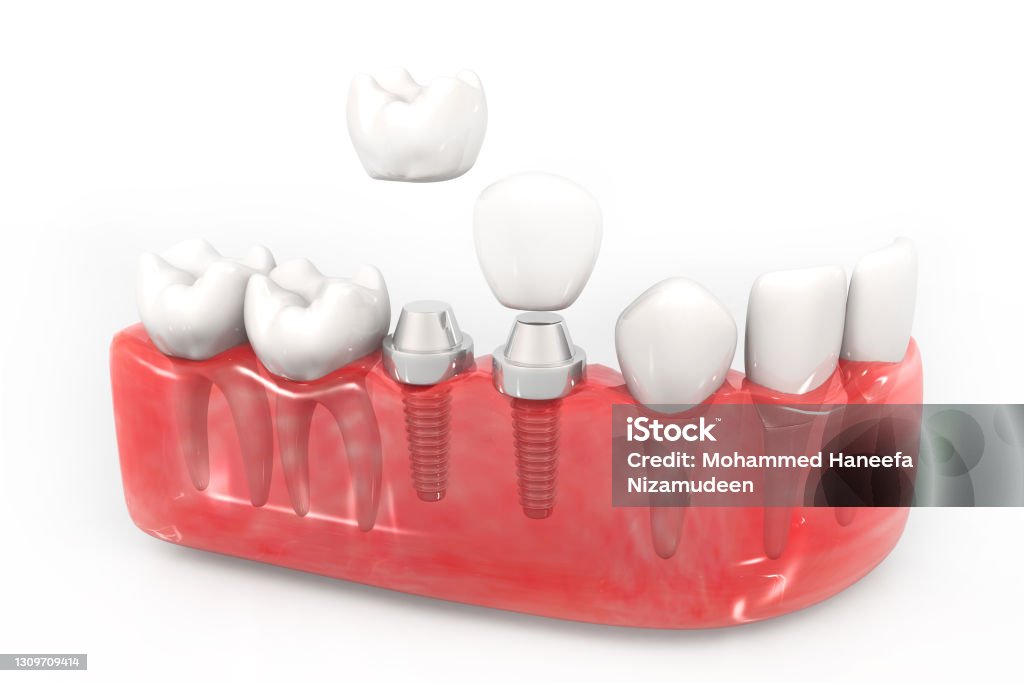 Dental implant installation process. 3d illustration Dental Implant Stock Photo