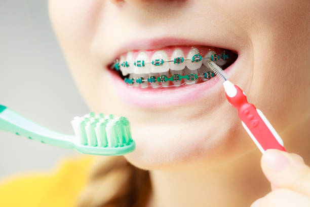 istock Girl with teeth braces using interdental and traditional brush 1309722377