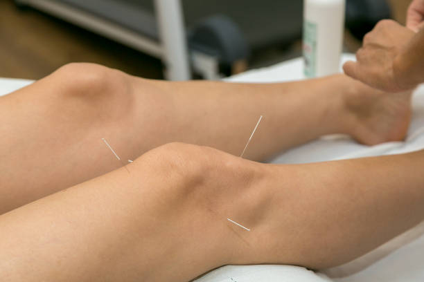 akupunktur am knie, behandlung von arthrose im knie - akupunkturnadel fotos stock-fotos und bilder