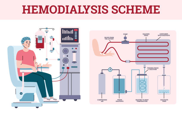 illustrations, cliparts, dessins animés et icônes de système rénal d’hémodialyse avec équipement pour le traitement de l’insuffisance rénale - dialyse