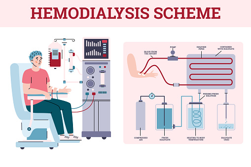 Hemodialysis Renal Scheme With Equipment For Treatment Kidney Diseases  Failure Stock Illustration - Download Image Now - iStock