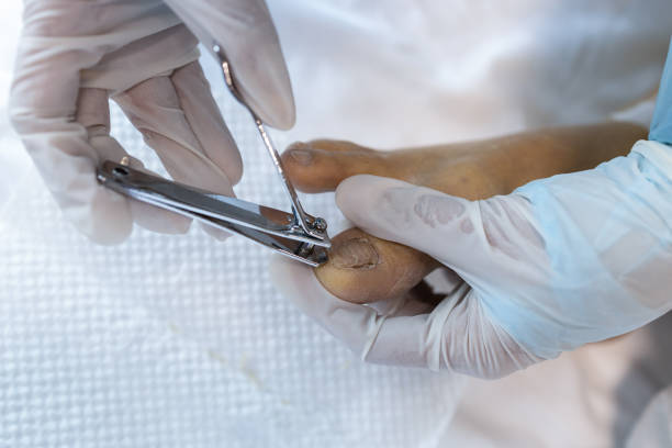 Close up,Hand of caregiver hold a nail clipper,cutting the ingrown nail for senior grandmother,asian nurse help to cut the toe nail for the old elderly at nursing home,pedicure,foot nail care,hygiene de cerca, mano del cuidador sostener un cortauñas, cortar la uña encarnada para la abuela mayor, enfermera asiática ayudar a cortar el dedo del pie clavo para los ancianos en el hogar de ancianos, pedicura, cuidado de uñas del pie, higiene