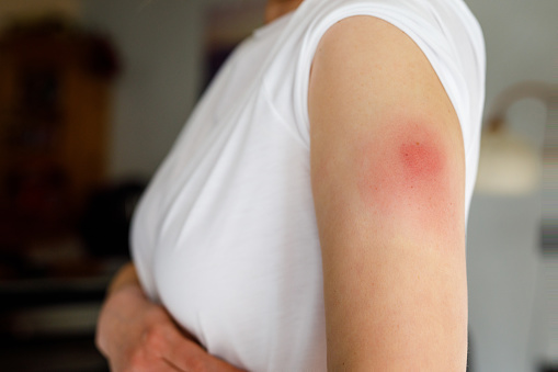 Reacción de vacunación en el brazo de la mujer después de la inyección de la vacuna contra el virus corona covid. Parte hinchada, sitio de pinchazo rojo. Persona irreconocible. photo