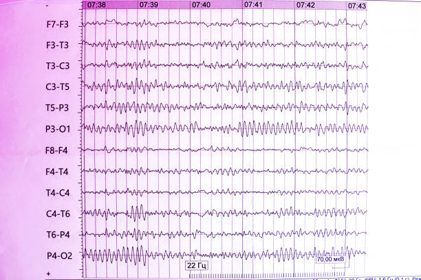 Results of electroencephalogram on paper, diagnostics of epilepsy The results of the electroencephalogram on paper, diagnostics of epilepsy eeg stock pictures, royalty-free photos & images