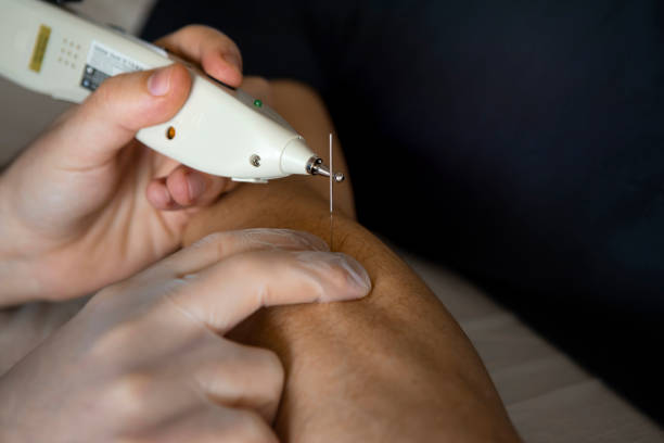 istock Deep dry needling for arm muscle. 1310059671