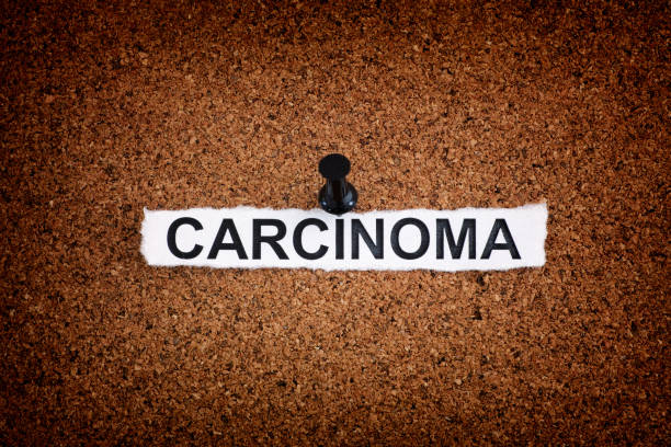 Torn piece of paper with the word Carcinoma pinned on a cork board Carcinoma. Torn piece of paper with the word Carcinoma pinned on a cork board. Close up. squamous cell carcinoma photos stock pictures, royalty-free photos & images