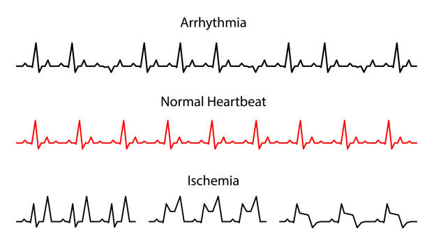 ilustrações, clipart, desenhos animados e ícones de definir linhas batimentos cardíacos normais, arritmia e isquemia. - heartbeat