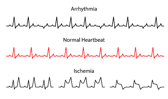 Set Lines heartbeat normal, arrhythmia and ischemia. Line cardiogram heart on white background.  Vector illustration. electro-cardiogram