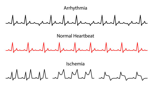 Set Lines heartbeat normal, arrhythmia and ischemia. Set Lines heartbeat normal, arrhythmia and ischemia. Line cardiogram heart on white background.  Vector illustration. electro-cardiogram outline stock illustrations