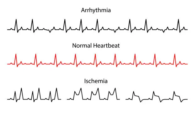 Vector illustration of Set Lines heartbeat normal, arrhythmia and ischemia.