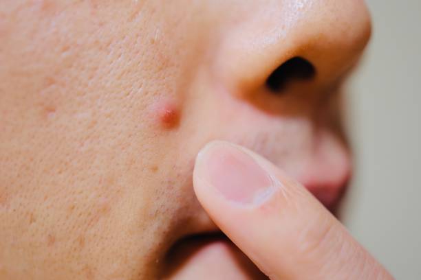Acne of a Japanese man stock photo