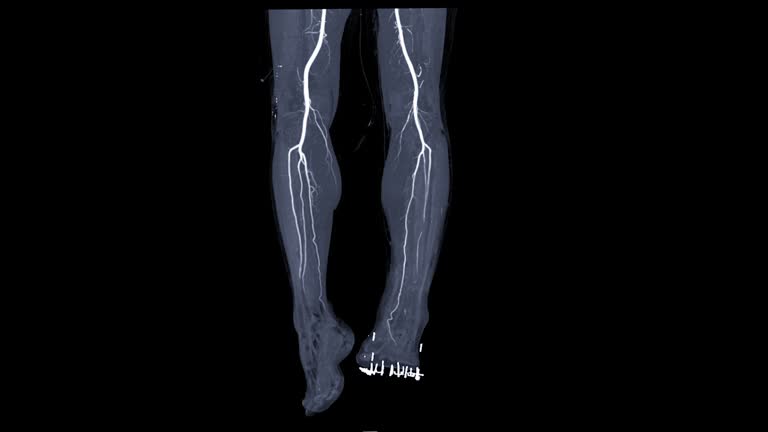 CTA Leg or CT angiography of the leg turn around on the screen for detect peripheral arterial disease.