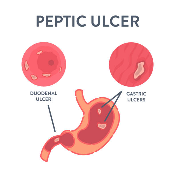 ilustraciones, imágenes clip art, dibujos animados e iconos de stock de úlcera péptica estomacal detectada por procedimiento de endoscopia - ulceras duodenales