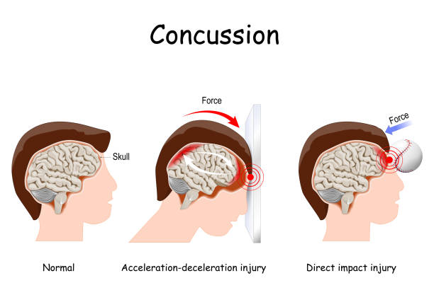 concussion in sport. mild traumatic brain injury concussion in sport. mild traumatic brain injury (mTBI). Concussions that caused by a direct blow of a baseball, and by indirect trauma to the head. vector illustration. educational poster. comparison and difference between normal brain, and brain after trauma concussion stock illustrations