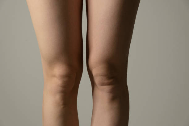 istock Overweight knees, contrast lightning. Woman`s hips closeup raw studio shot in grey background. Dieting and fat loss concept. 1310319618