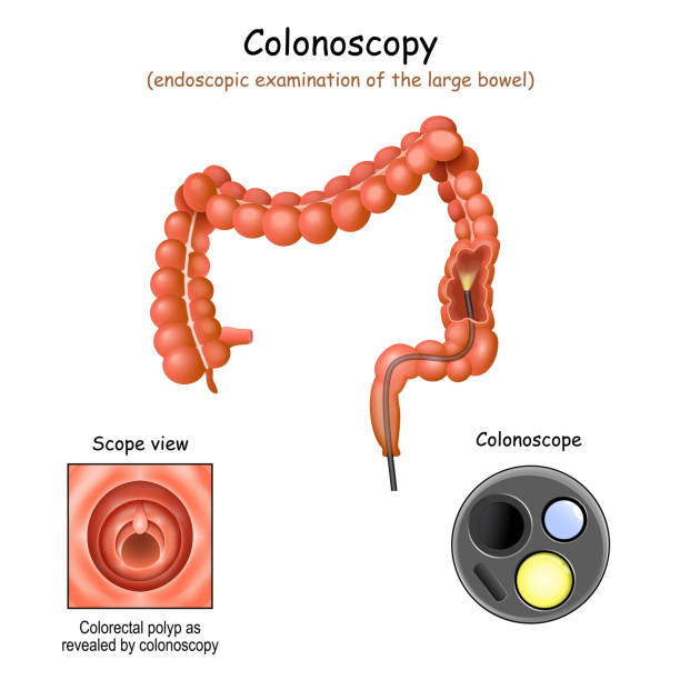 colonoscopy in the large bowel. colonoscopy in the large bowel. Close-up of colonoscope, and Colorectal polyp. Cross section of a colon. Vector illustration colon cancer screening stock illustrations