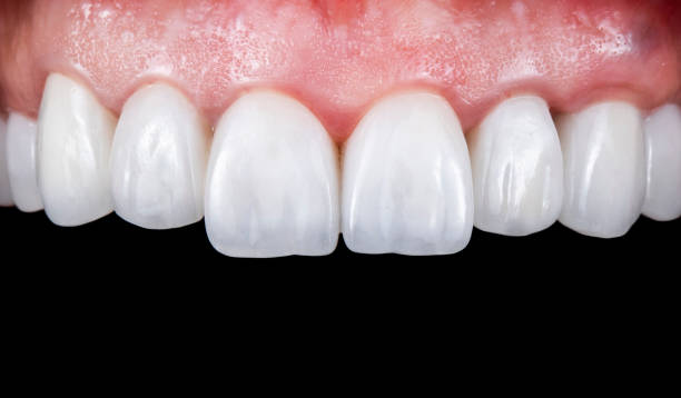 neues lächeln durch kronenimplantate und furniere geschaffen - menschlicher zahn fotos stock-fotos und bilder