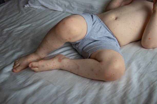 A toddler boy with rash infected by Roseola Infantum Disease. Roseola is a contagious illness that caused by a virus. stock photo