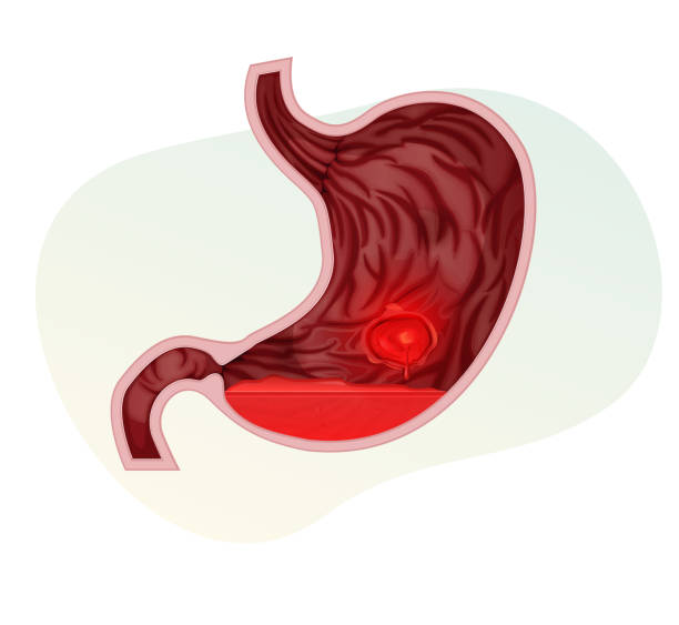 wrzód trawienny - ból brzucha - ilustracja - peptic ulcer stock illustrations