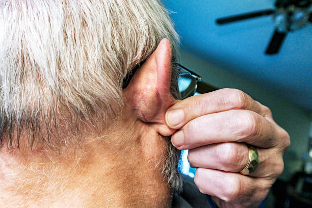 Close-up of a real person, real life senior adult man who has been wearing protective face masks for more than a year because of the Covid-19 coronavirus pandemic pulling his ear away from his head to show the chapped and raw peeling skin condition behind the ear where coarse elastic loops holding the masks in place constantly scrape his skin.