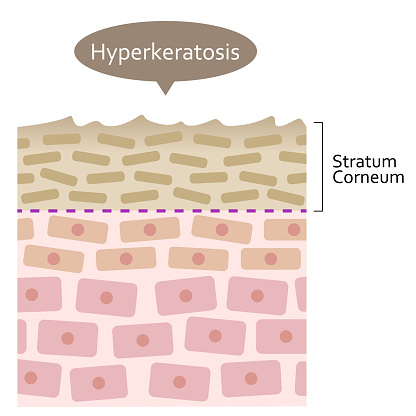 Hyperkeratosis is thickening of Keratin in Epidermis. Health and beauty skin care illustration
