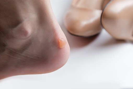 Callus blisters on woman's feet. Uncomfortable shoes problems.