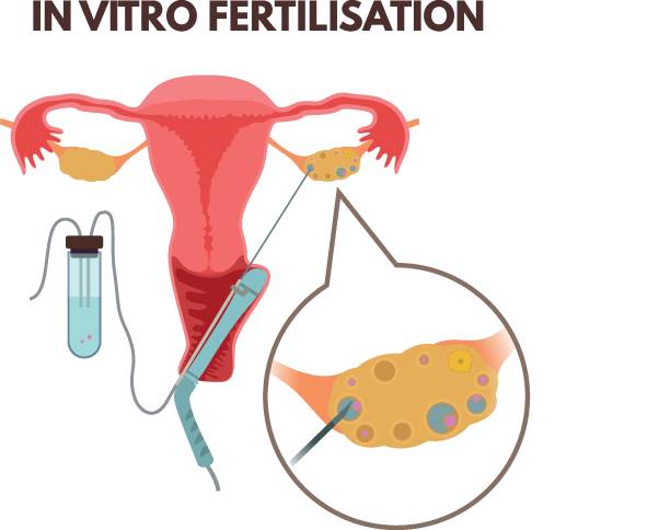 ilustrações, clipart, desenhos animados e ícones de fertilização in vitro - retrieval
