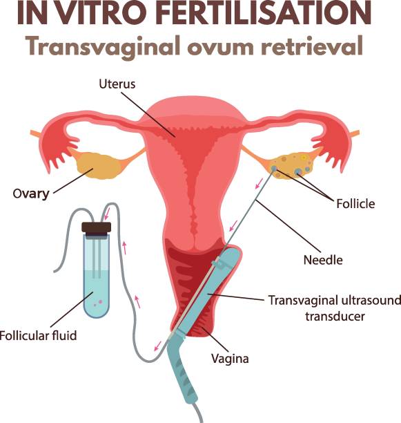 ilustrações, clipart, desenhos animados e ícones de fertilização in vitro - retrieval
