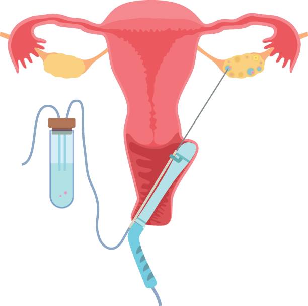 in-vitro-fertilisation - retrieval stock-grafiken, -clipart, -cartoons und -symbole