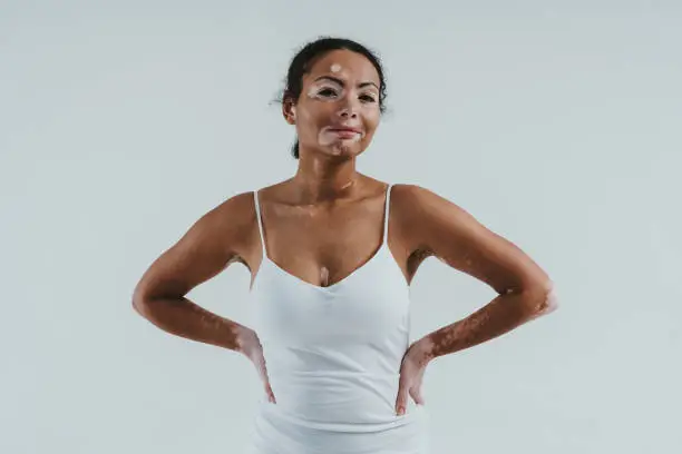 Photo of Beautiful woman with vitiligo skin posing in studio. Concept about body positivity and self acceptance